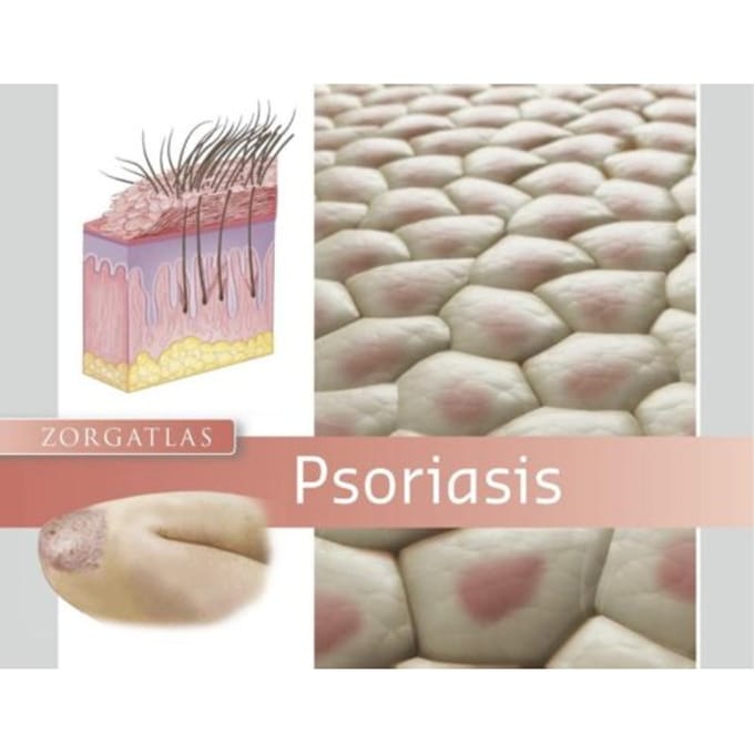 Psoriasis - Zorgatlas - R.C. Beljaards