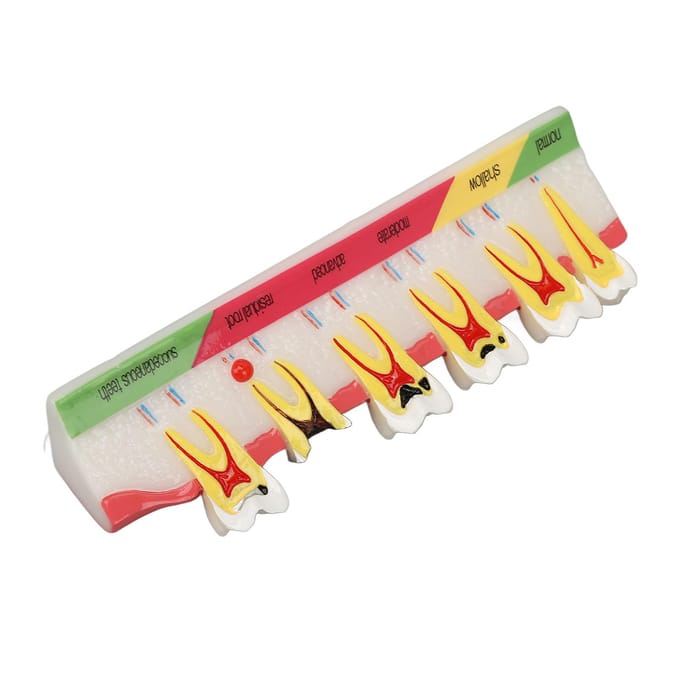 Model Tandbederf 6 Verschillende Stadia Hars Verrotte Tand Displaymodel white