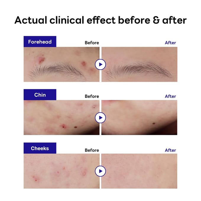 [MEDIHEAL] Derma Clear Teatree Trouble Spot-pleister 44EA gray