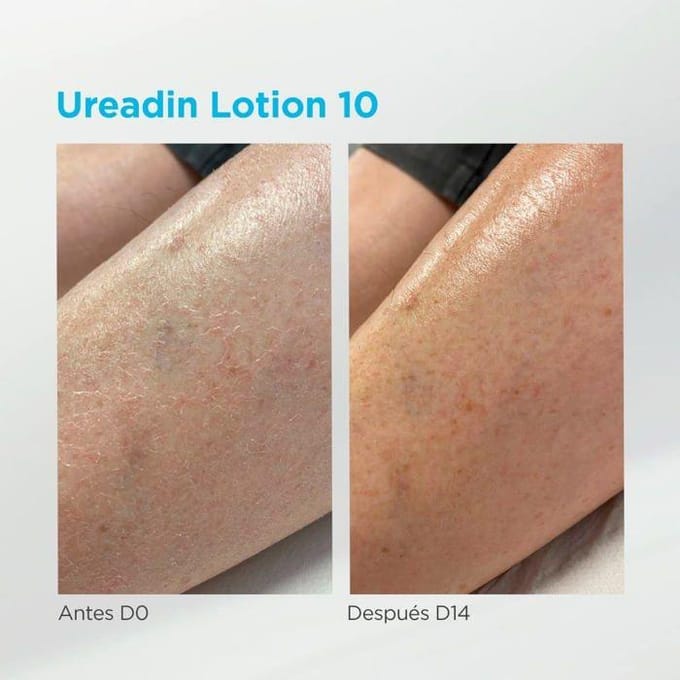 Massage Lotion - ISDIN - UREADIN - Hydraterend - Geurloos - Vette Huid