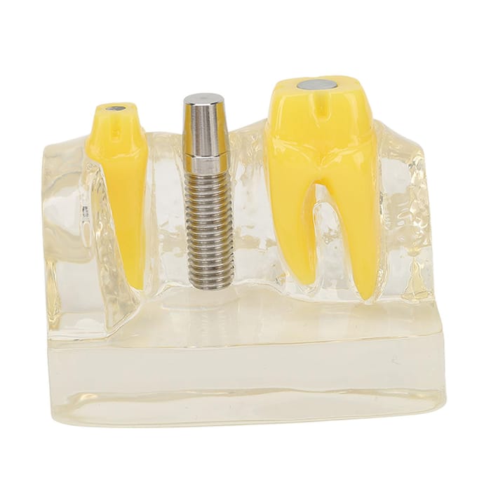 Modèle d'implant dentaire transparent, enseignement dentaire, recherche, démonstration, modèle de dents yellow