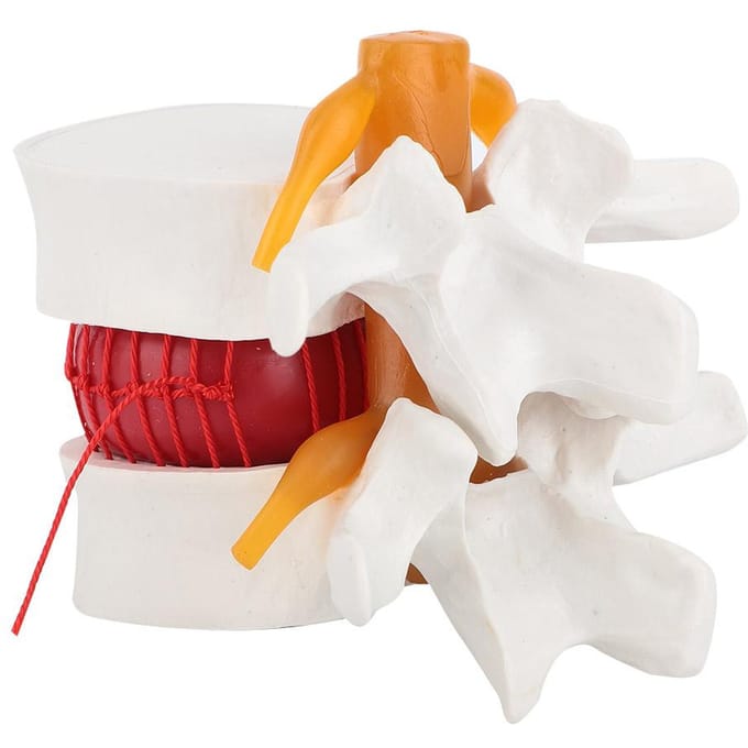 1:1.5 Medisch Demonstratiemodel van de Lendenwervelkolom Menselijk Model van een Hernia Lumbalis white