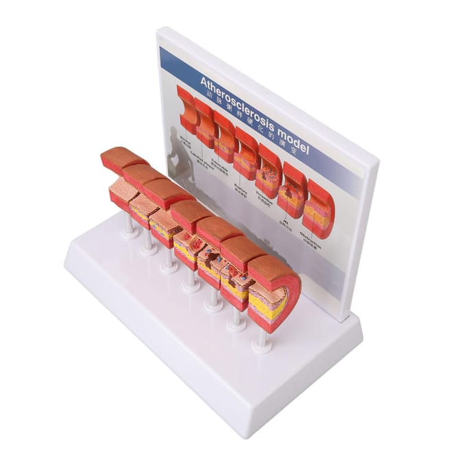 7 STUKS Arterie Anatomie Model Anatomisch Bloedvat Aderverkalking Trombus Vasculair Model voor Artsen brown
