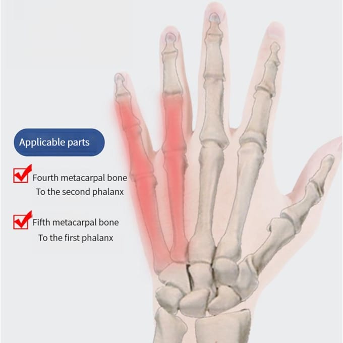 1 verpakking Pinky Splint Hand Rest voor Pink Gips, Trigger Finger Vaste Rechttrekker beige