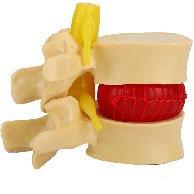 1:1.5 Lendenwervelschijf Hernia Demonstratiemodel Studie Leer Menselijke Wervelkolom beige
