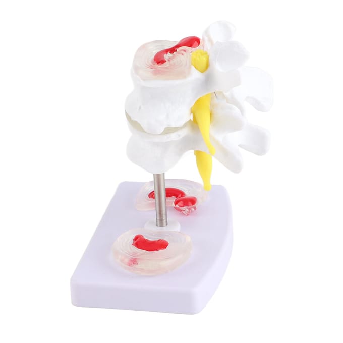 Anatomisch Lendenwervelschijf Hernia Demonstratiemodel Menselijke Wervelkolom School Trainingsmateriaal white
