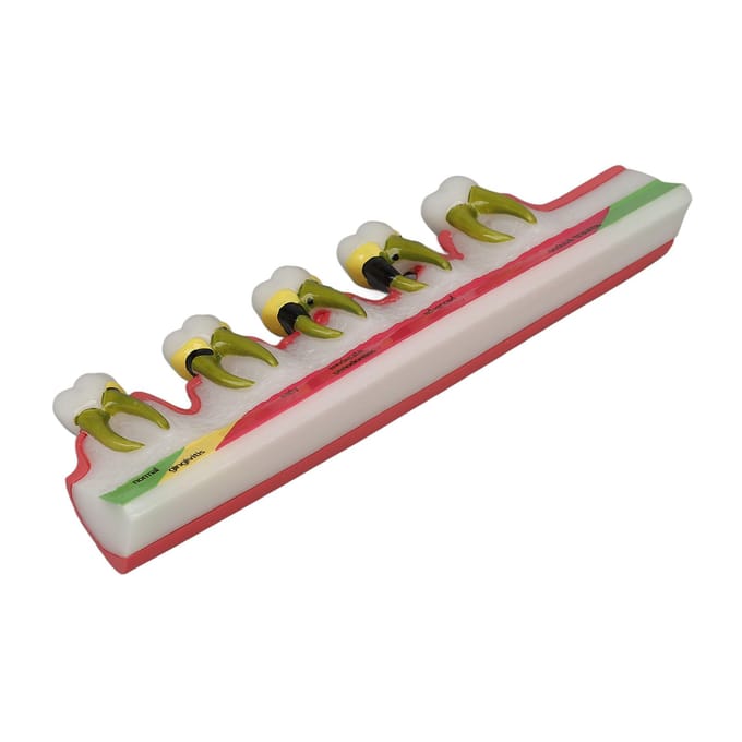 Tanden Parodontale Aandoening Model Verschillende Stadia Hars Tandheelkundig Parodontitis Display Model red