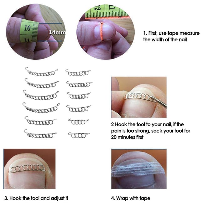 12StuksDoos Ingegroeide Teennagel Correctiedraad Fixeer 6 Maten Ingegroeide Teen Corrector Pedicure Behandeling white