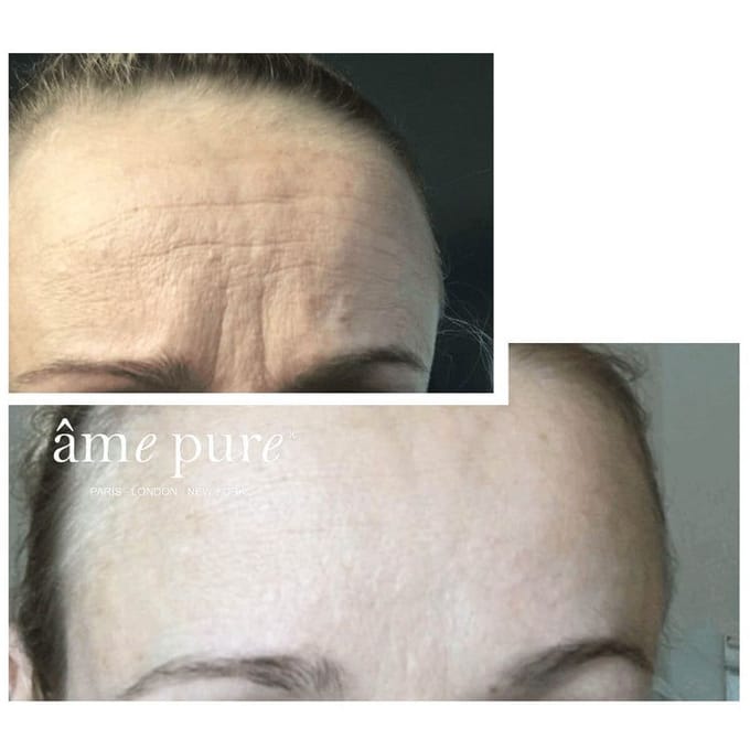 âme pure WRINKLERASER BASIC 0.5 mm - Anti-Aging Microneedling Derma Roller Set