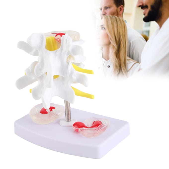 Anatomisch Lendenwervelschijf Hernia Demonstratiemodel Menselijke Wervelkolom School Trainingsmateriaal white