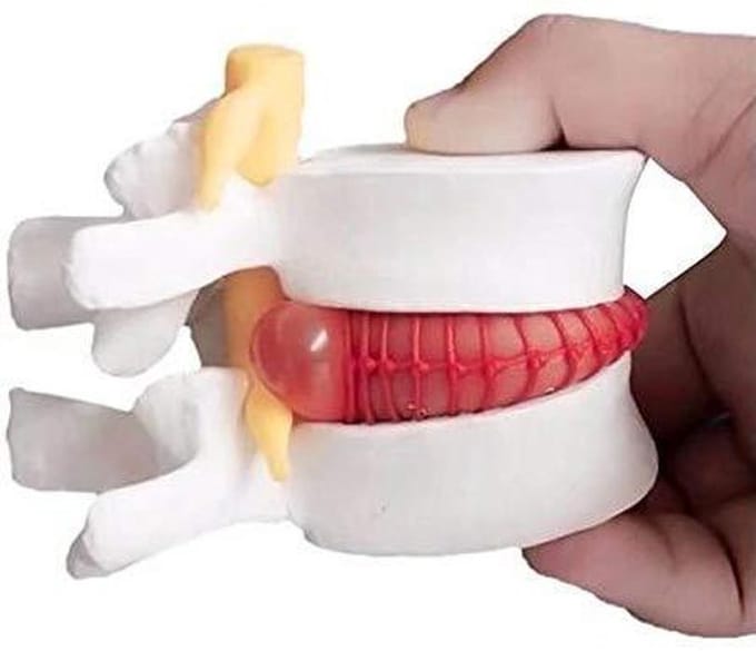 Wervelkolom Model - Anatomisch Model - Onderwijs Demonstratie - Pathologische Presentatie - 5-Wervel Segment - Multicolor