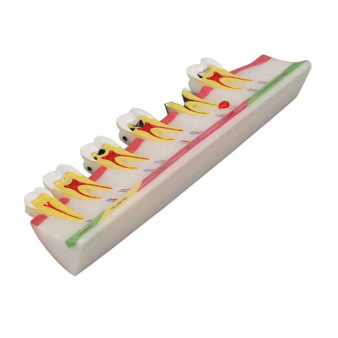 Model Tandbederf 6 Verschillende Stadia Hars Verrotte Tand Displaymodel white