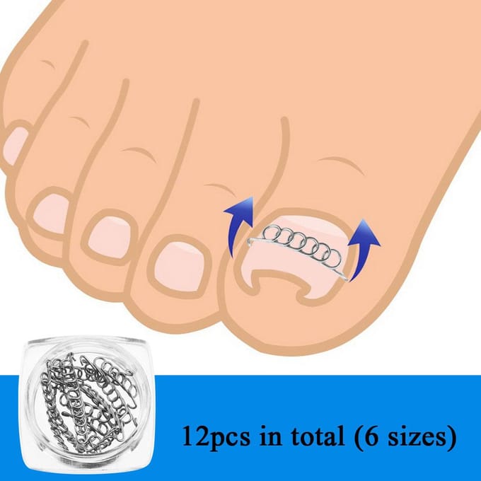 12StuksDoos Ingegroeide Teennagel Correctiedraad Fixeer 6 Maten Ingegroeide Teen Corrector Pedicure Behandeling white