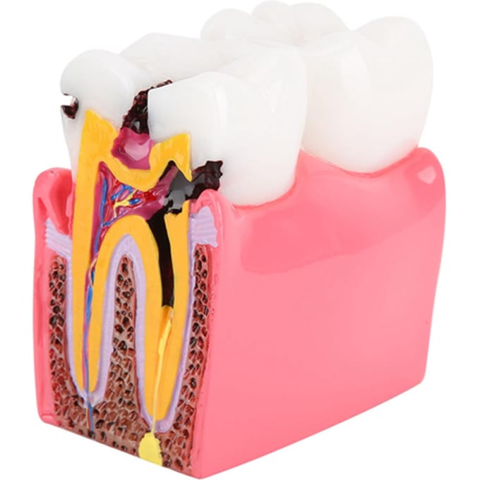 Modèles d'étude de comparaison de caries Dentiste Éducation Anatomie Dentaire Modèle de Dents blanc
