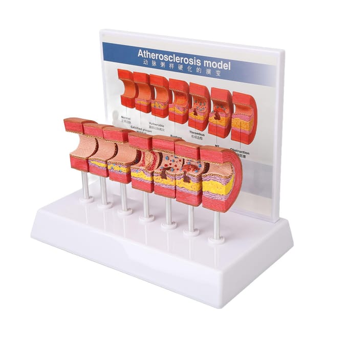 7 STUKS Arterie Anatomie Model Anatomisch Bloedvat Aderverkalking Trombus Vasculair Model voor Artsen brown