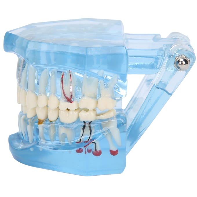 Modèle de dents dentaires Acrylique Bleu Transparent Enseignement Démonstration Simulation Modèle de dents white