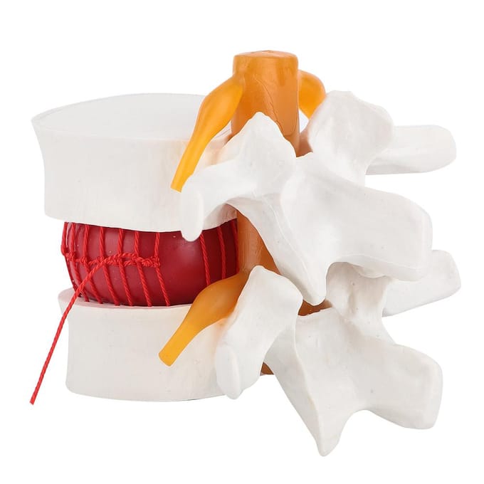 1:1.5 Medisch Demonstratiemodel van de Lendenwervelkolom Menselijk Model van een Hernia Lumbalis white