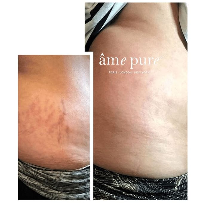 âme pure BODY BASIC | STRETCH MARKS - Microneedling Set Voor Striae, Littekens & Cellulite