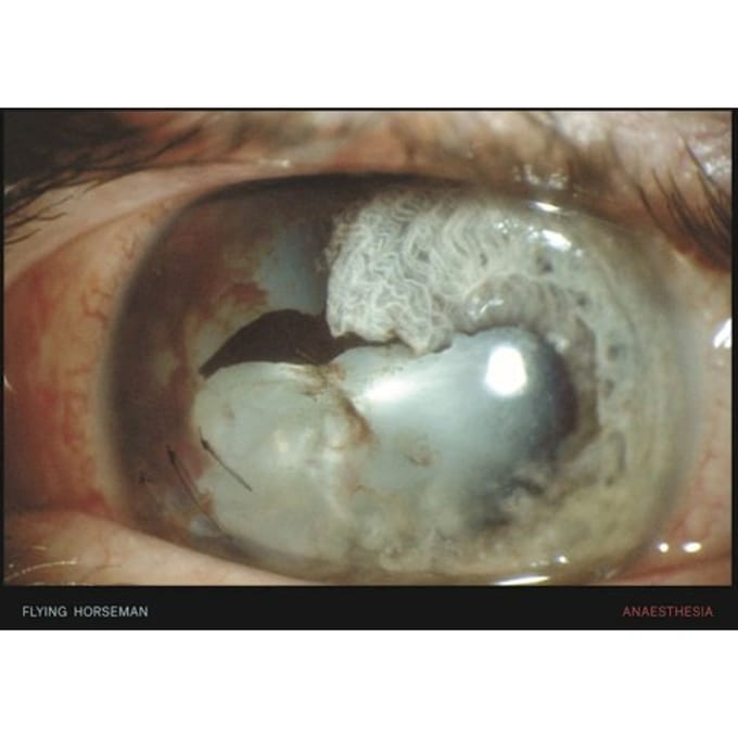 Flying Horseman - Anaesthesia (CD)