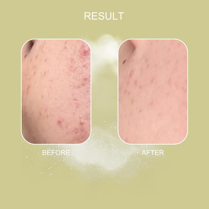 Health Peel TCA peel 25%, pH1.1. / TCA пилинг 25%, pH1.1, 30мл.